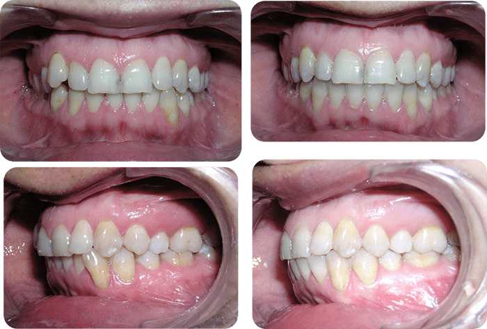 Moderate crowding before and after braces