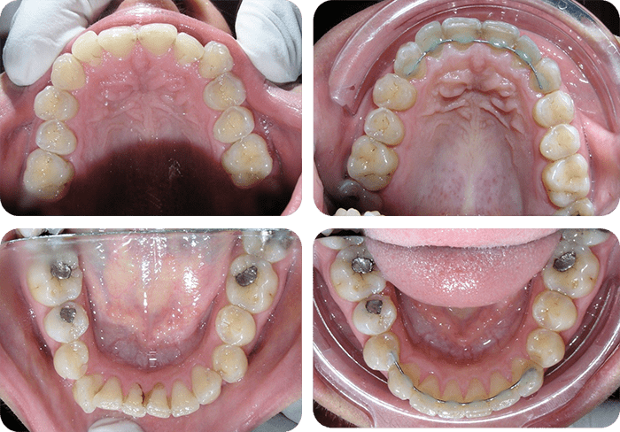 Spacing before and after clear aligners