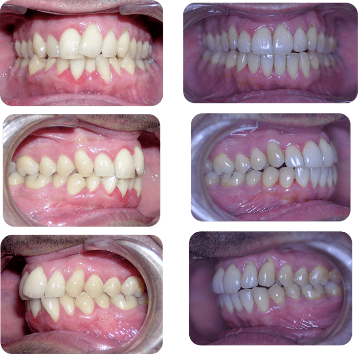 Severe crowding before and after braces and expander