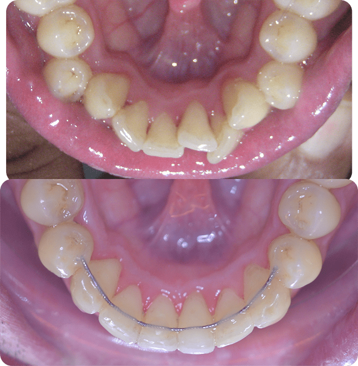 Spacing before and after clear aligners