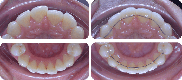 Severe crowding before and after braces