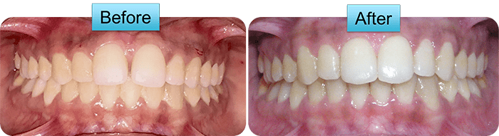 Severe crowding before and after braces and expander