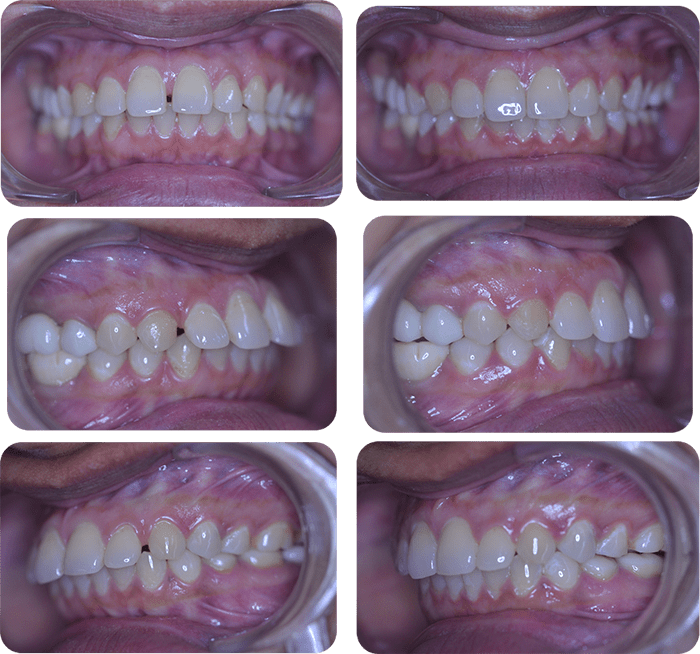 Spacing before and after braces