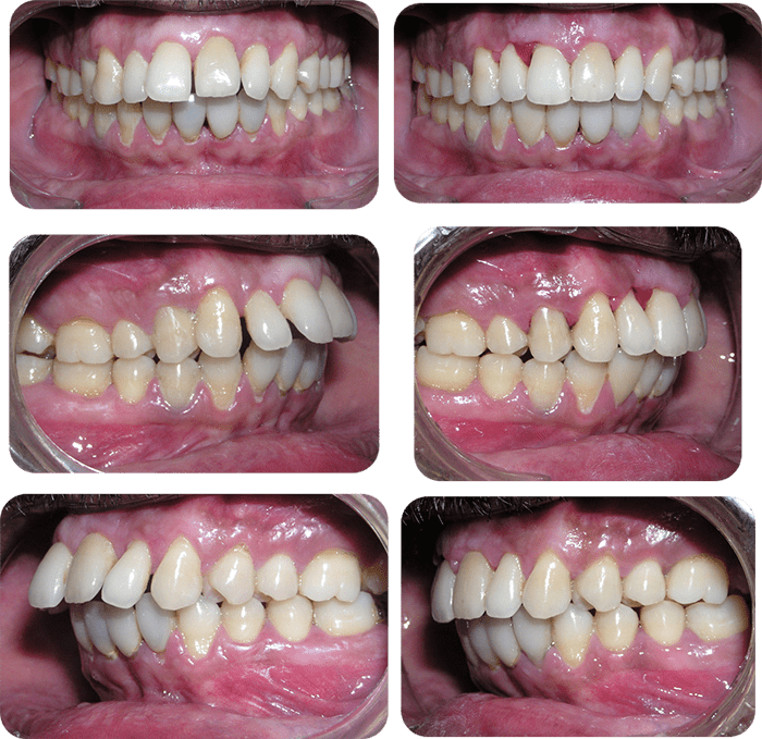 Severe crowding before and after braces and expander