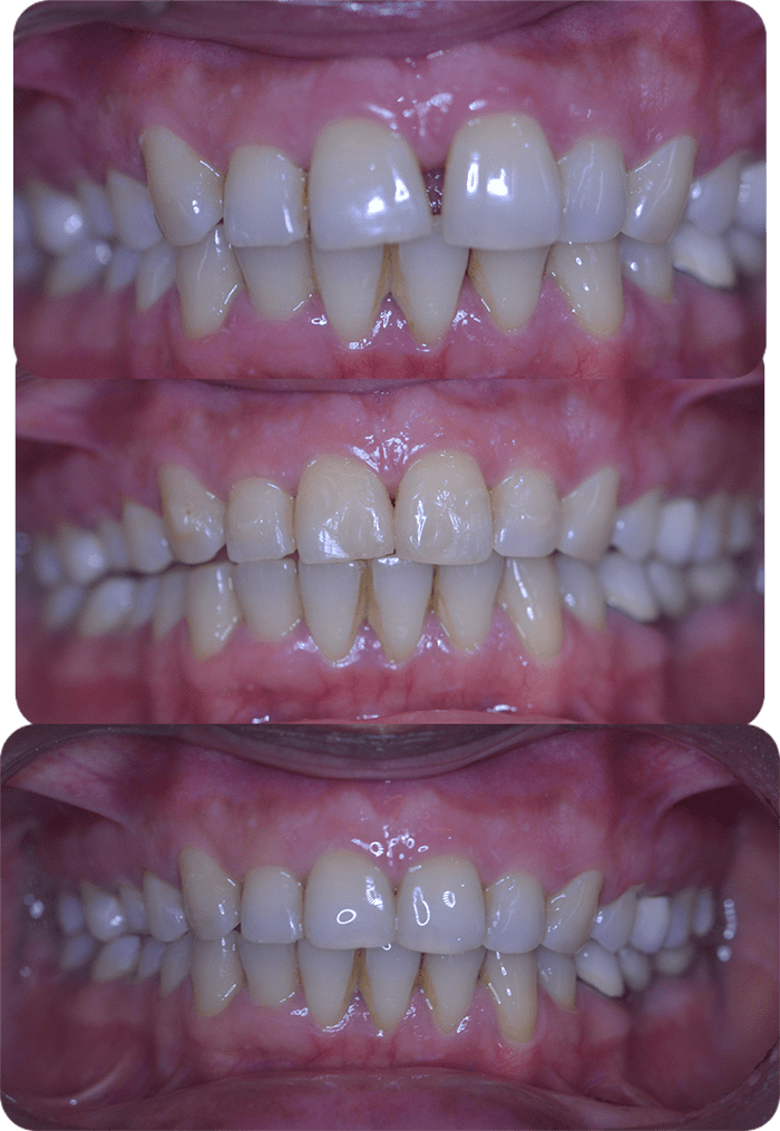 Spacing before and after braces