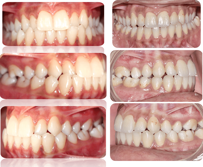 Severe crowding before and after braces and expander