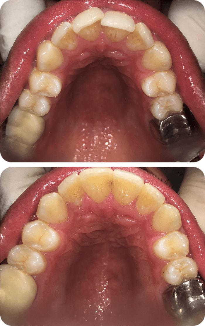 Spacing before and after braces