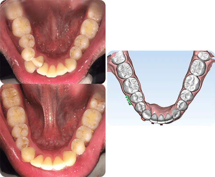 Severe crowding before and after braces and expander