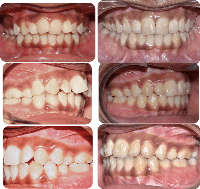 Spacing before and after braces