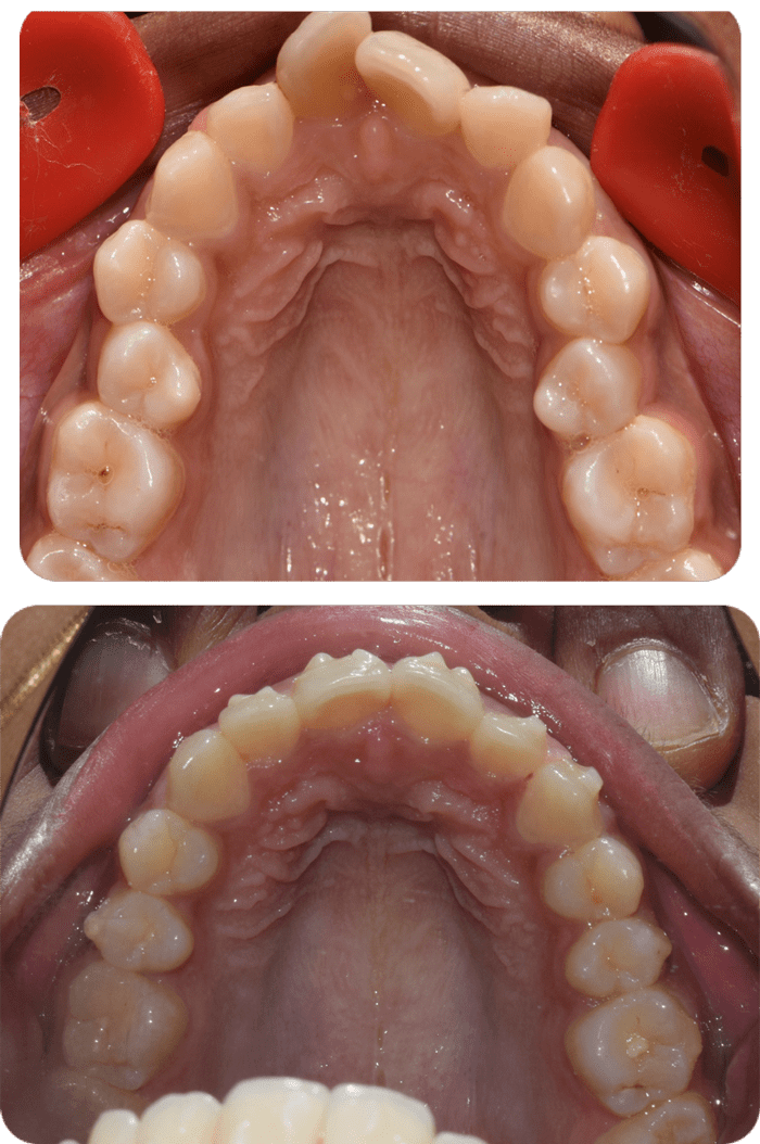 Severe crowding before and after braces and expander