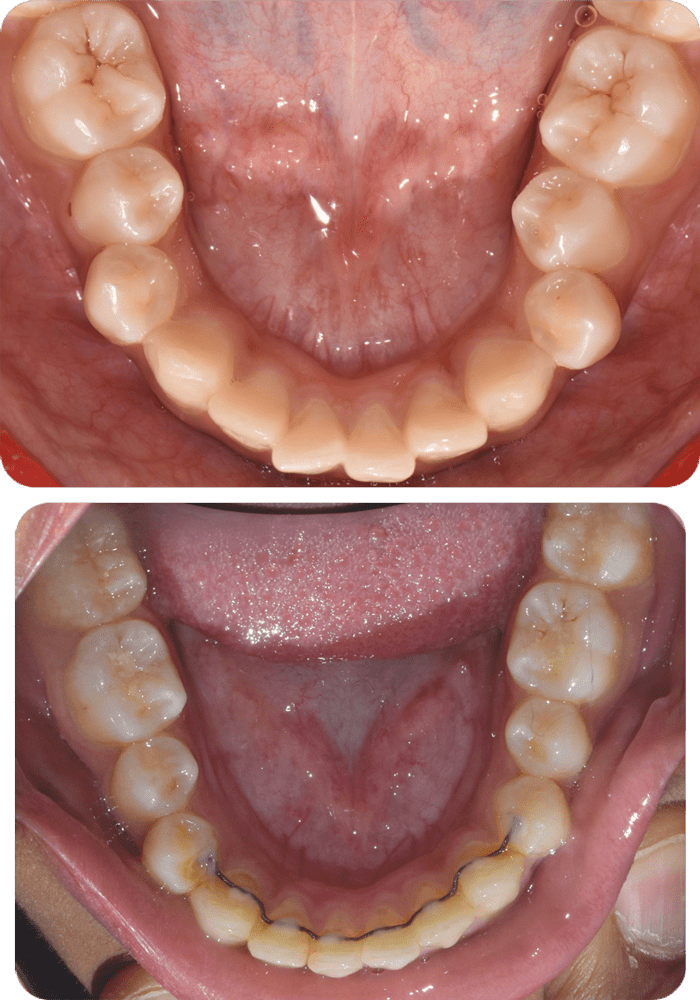 Severe crowding before and after braces and expander