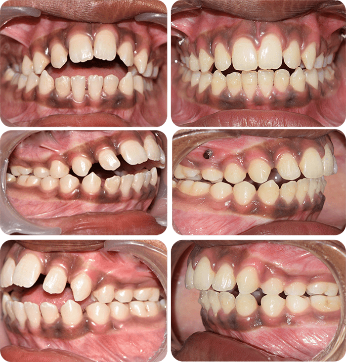 Spacing before and after braces