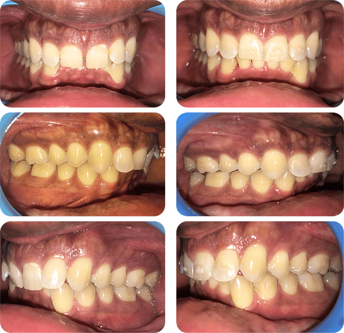 Severe crowding before and after braces and expander