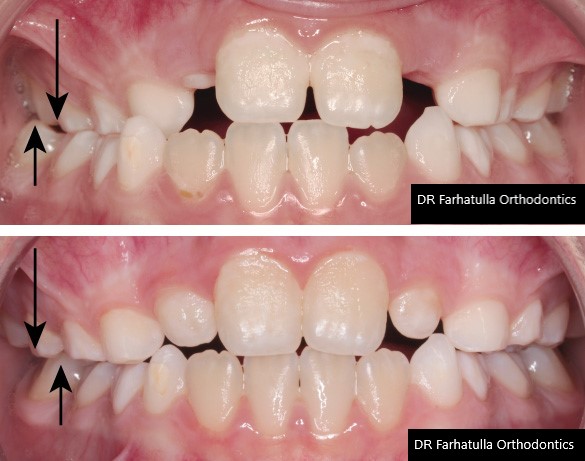 Crossbite before and after expander