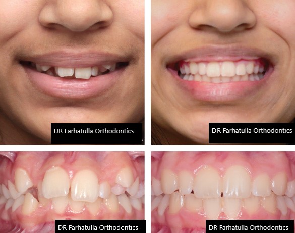 Deep bite before and after braces