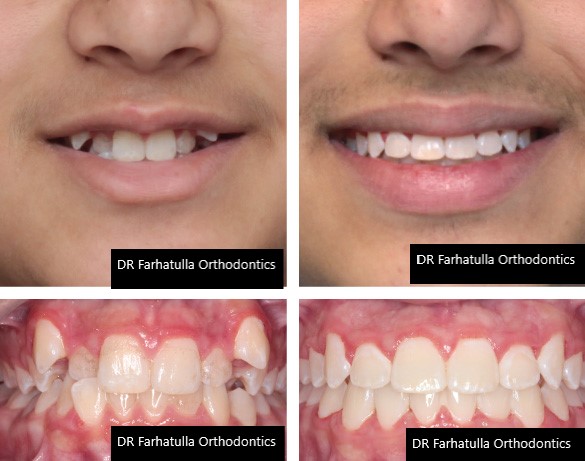 Moderate crowding before and after braces