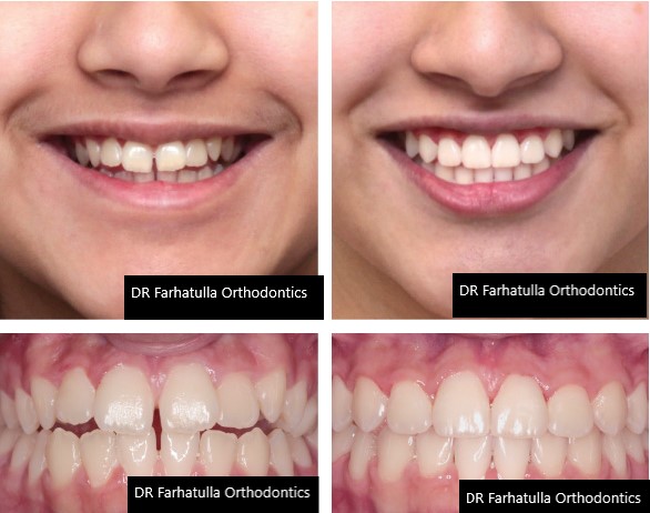 Open bite before and after braces