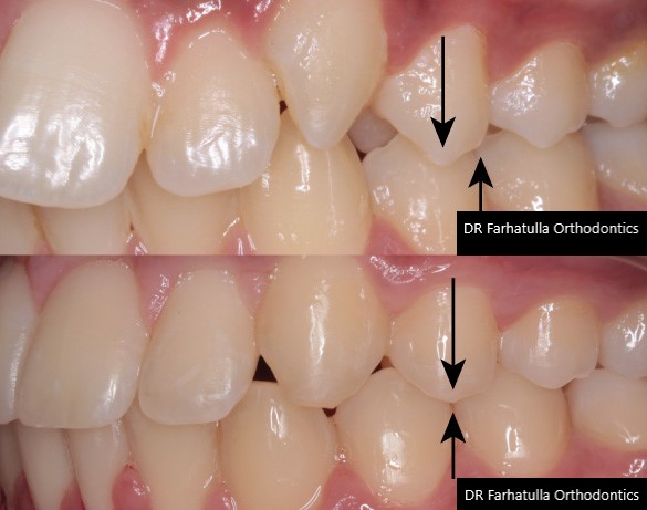 Overbite before and after braces