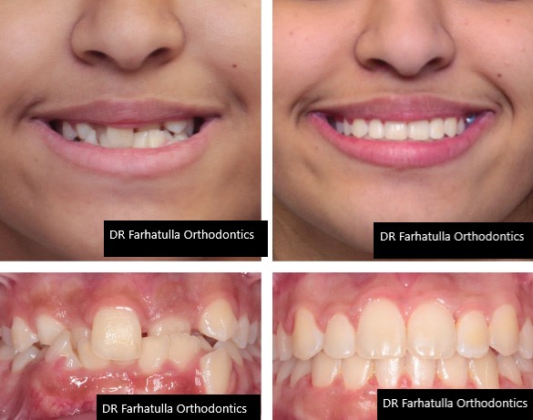 Severe crowding before and after braces