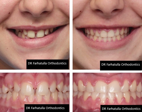 Spacing before and after clear aligners