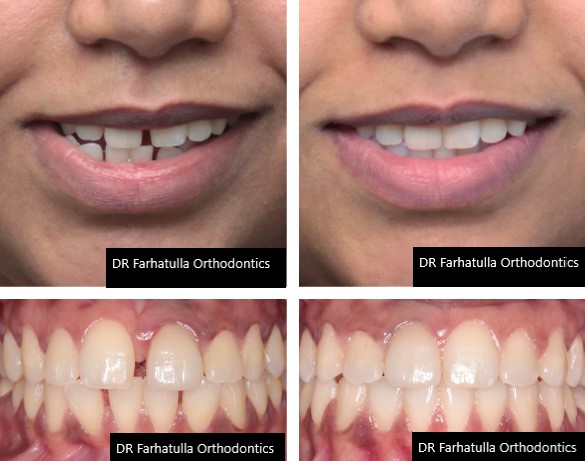 Severe crowding before and after braces and expander