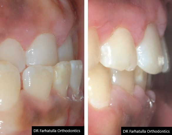 Underbite before and after braces